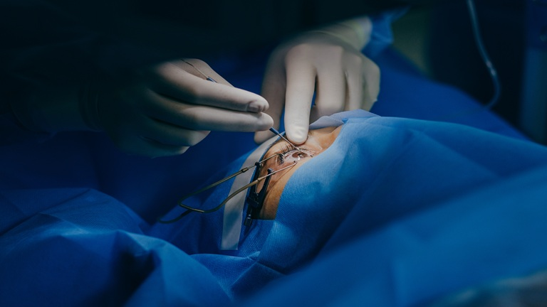 cataract-surgery-bangalore