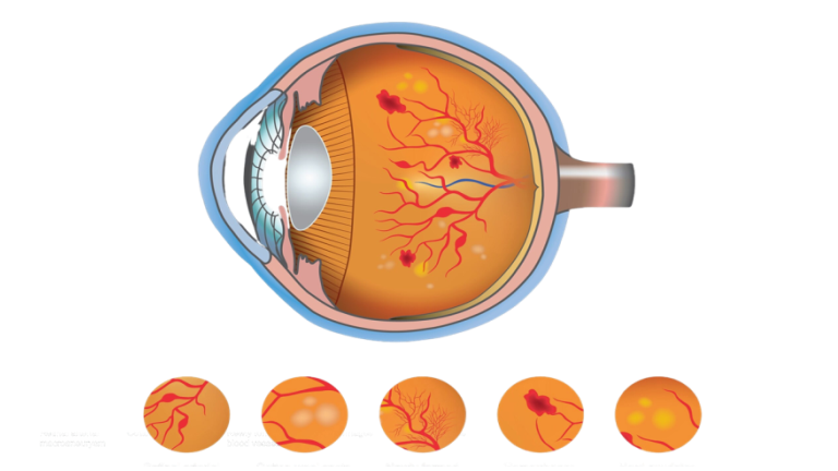 diabetic-retinopathy-treatment