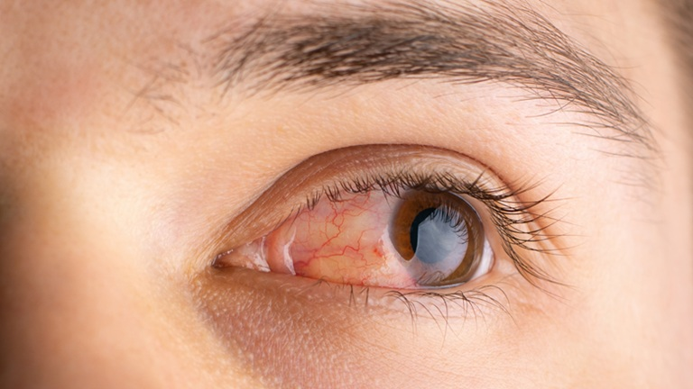 dry-eye-in-bangalore