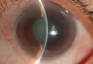 Acute angle closure Glaucoma Problem