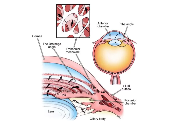 Narrow Angle Glaucoma Treatment