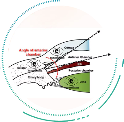 Gonioscopy Angle of Anterior Chamber