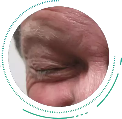 Blepharospasm Eye Condition