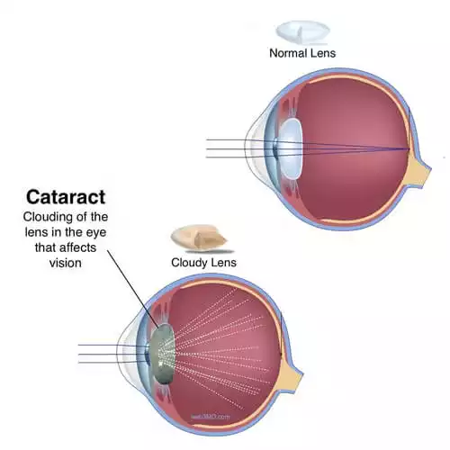Cataract Surgery in Bangalore Cataract Treatment