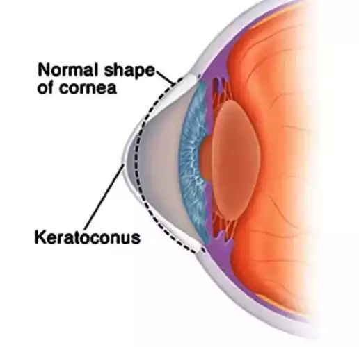 Problem caused by Keratoconus