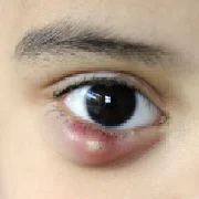 Chalazion Eyelid Problem