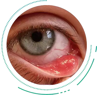 Chalazion Chalazion Eye Condition