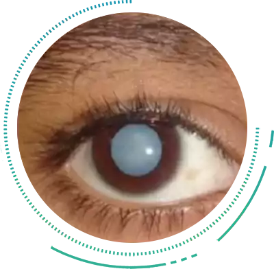 Congential Cataract Congential Cataract Eye