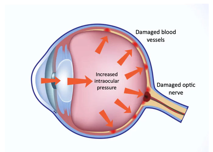 Congenital Glaucoma Treatment