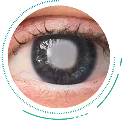 Cortical Cataract Eye