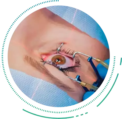 During Laser Eye Surgery During Lasik Surgery