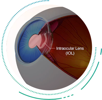 Cataract Extraction With Intraocular Implantation