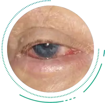 Ectropion & Entropion Ectropion & Entropion Eye Condition