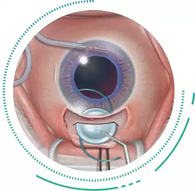 Extracapsular Cataract Eye Surgery