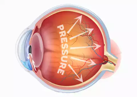 Glaucoma Treatment