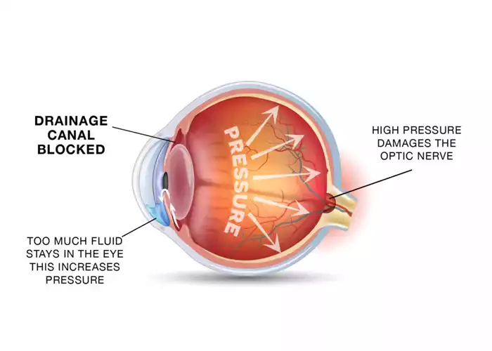 Glaucoma Surgery