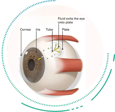 Implantation of Shunts Shunts for Glaucoma Surgery