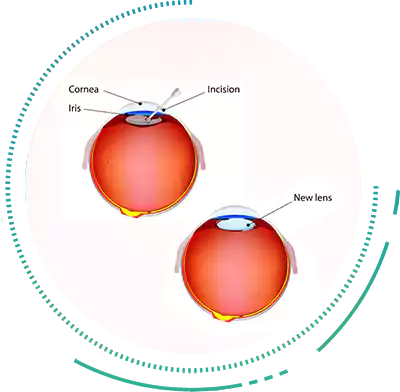 Surgical Options based on Patient Satisfaction Various Cataract Treatment Techniques for Patient