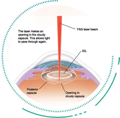 Laser Prophylactic Iridotomy Glaucoma Surgery