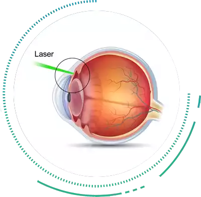 Glaucoma Laser Treatment in Bangalore