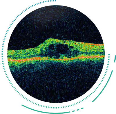 Optical Coherence Tomography Optical Coherence Tomography Scan