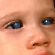 Glaucoma for Children