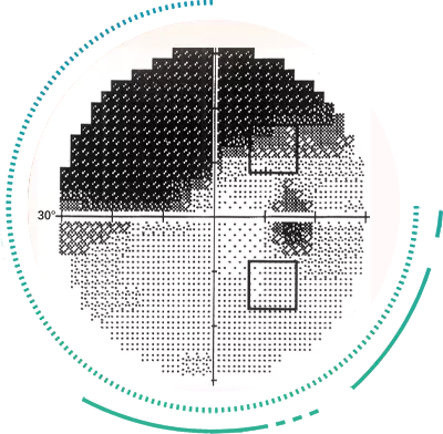 Perimetry Visual Analysis