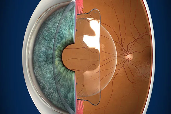 Phakic Intraocular Lens Implantation