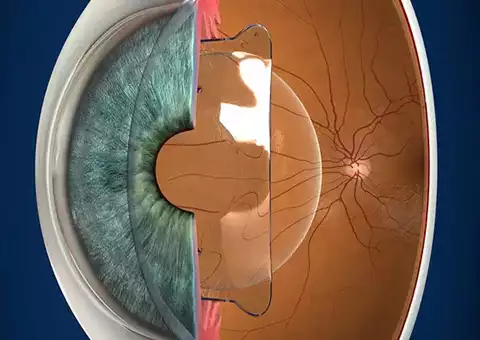 Phakic Intraocular Lens