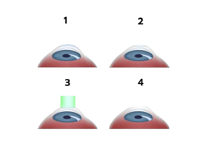 Photorefractive Keratectomy Photorefractive Keratectomy Surgery