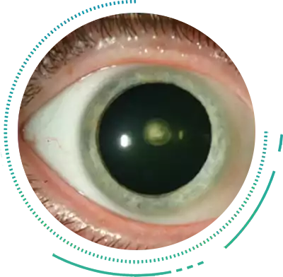 Posterior Subcapsular Cataract Eye