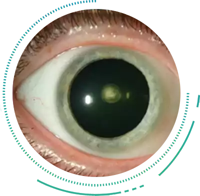 Posterior Subcapsular Cataract Posterior Subcapsular Cataract Eye