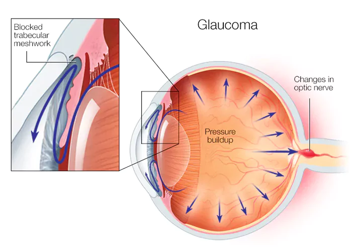 Primary Open Angle Glaucoma (POAG) Primary Open Angle Glaucoma Treatment