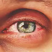 Redness in Eye