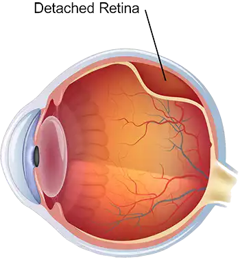 Retinal Detachment Treatment