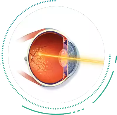 Retinal LASER photocoagulation Treatment