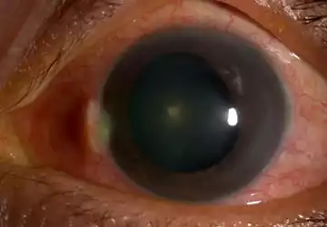 Secondary Angle Closure Glaucoma