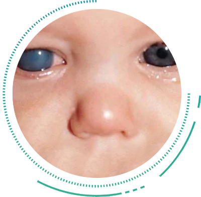 Symptoms of Glaucoma Causes & Symptoms of Glaucoma