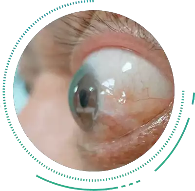 Thyroid Eye Condition