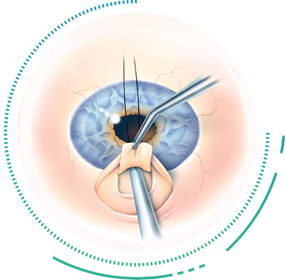 Trabeculetomy Trabeculetomy Glaucoma Surgery