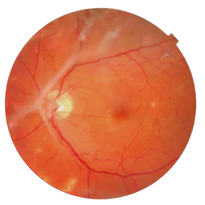 tractional retinal detachment vitrectomy