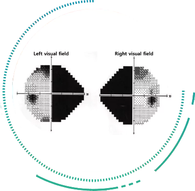 Visual Field Perimetry Test Visual Field Analysis by Perimetry