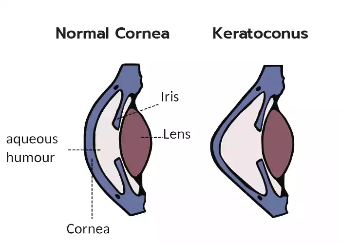 What Happens in Keratoconus