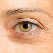 Wrinkles, scars around Eyes