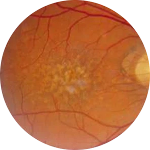 Age Related Macular degeneration Treatment