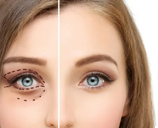 Outcome of Oculoplastic Surgery