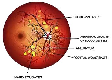 Causes of Diabetic Retinopathy