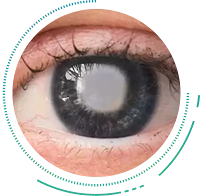 Cortical Cataract Cortical Cataract Eye