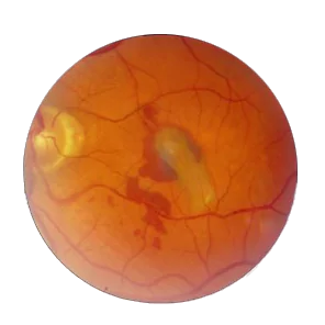 Exudative Retinal Detachment Surgery