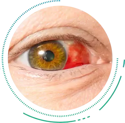 Eye Trauma Eye Trauma Complication